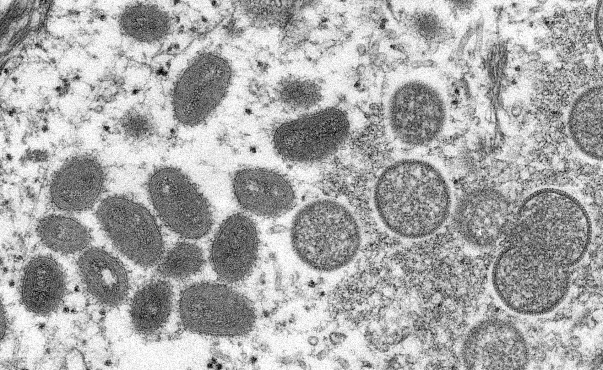 Monkeypox: mais de mil casos registados em países não endémicos