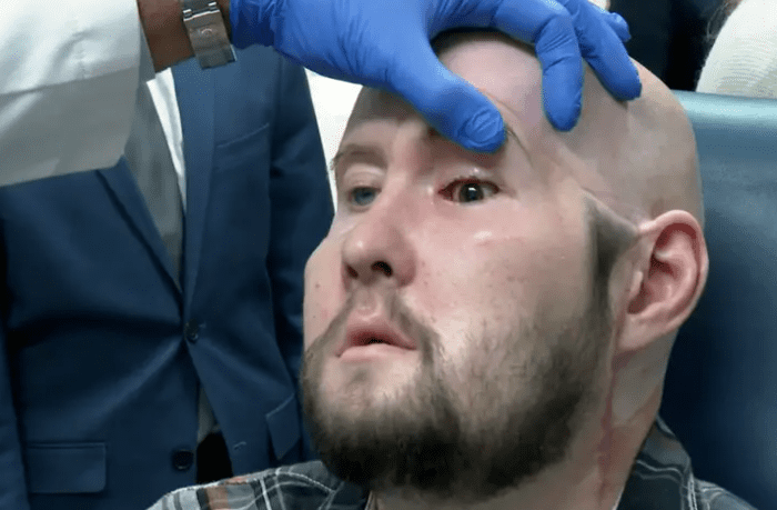 Hospital consegue transplantar um olho inteiro num paciente pela primeira vez